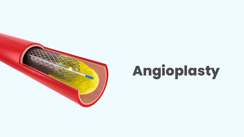 Angioplasty