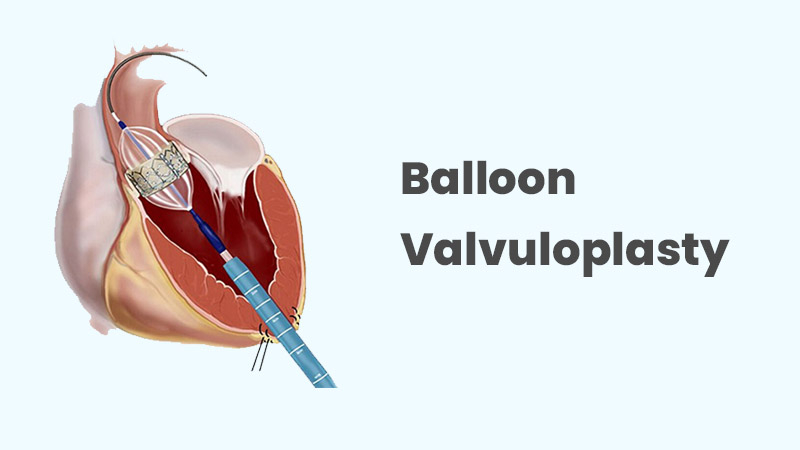 Balloon-Valvuloplasty.jpg