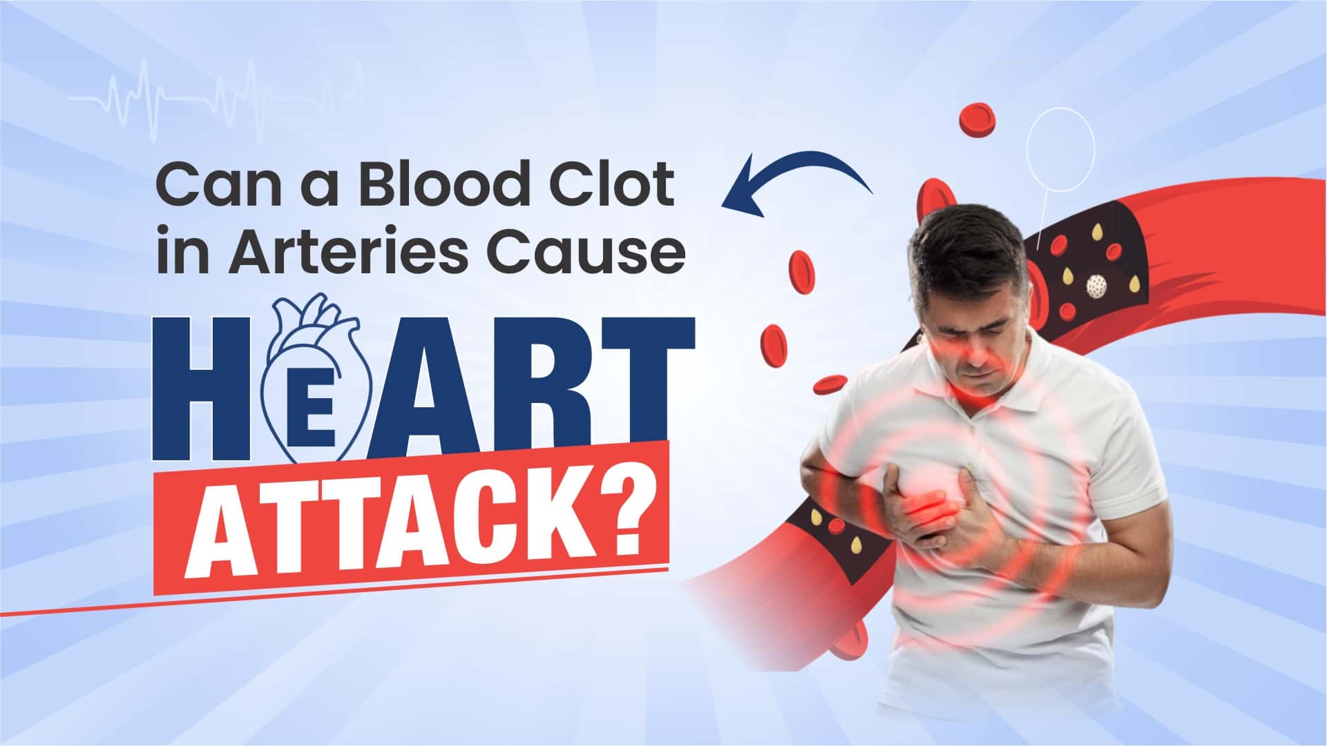Can a Blood Clot in Arteries Cause Heart Attack?