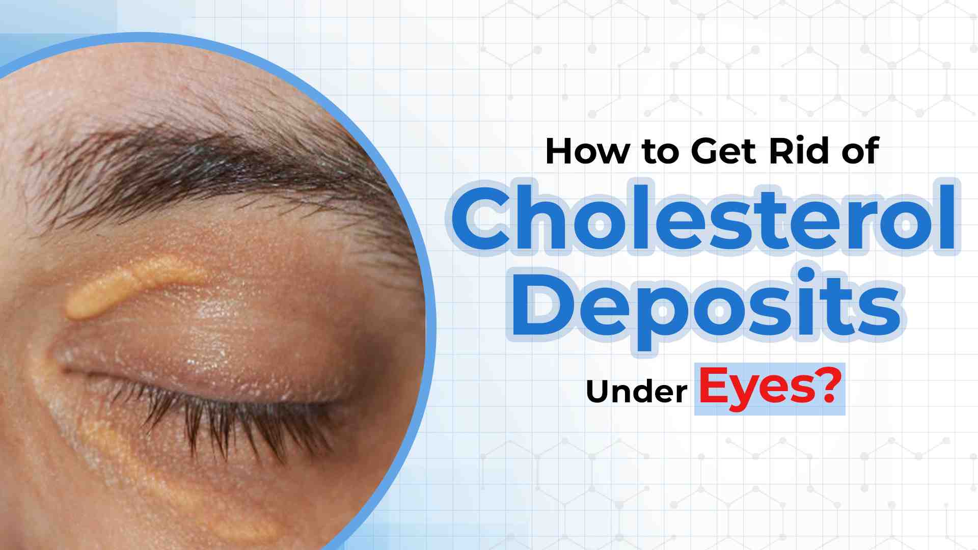 How to Get Rid of Cholesterol Deposits Under Eyes?