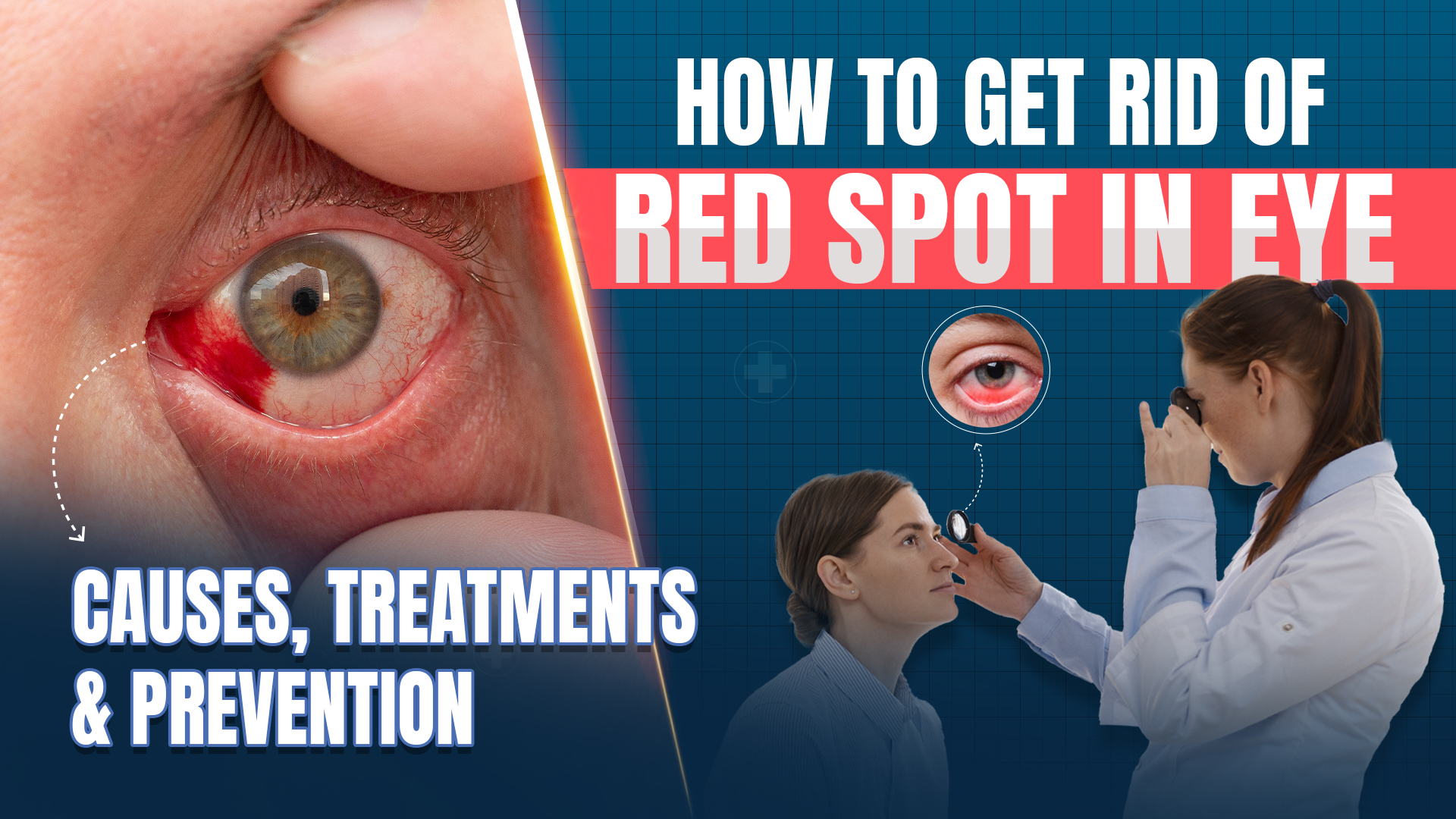 How to Get Rid of Red Spot in Eye: Causes, Treatments, and Prevention