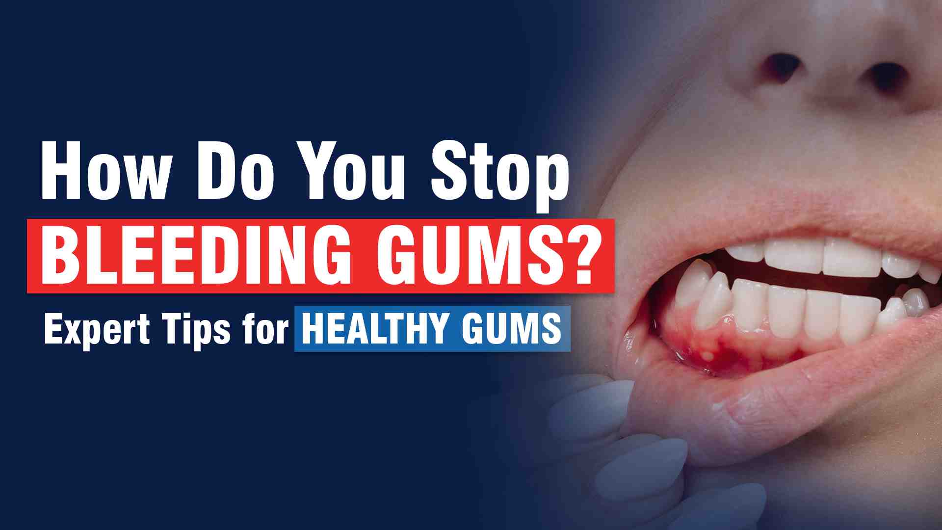 How Do You Stop Bleeding Gums? Expert Tips for Healthy Gums