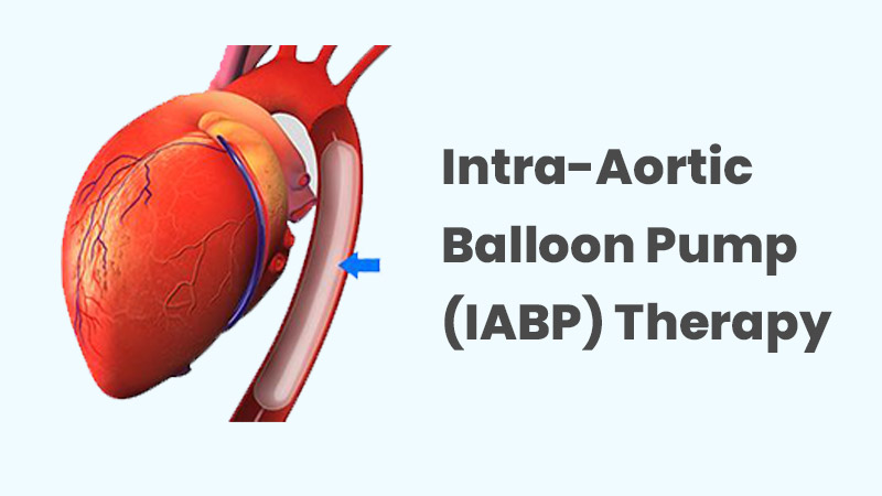 Intra-Aortic Balloon Pump (IABP) Therapy