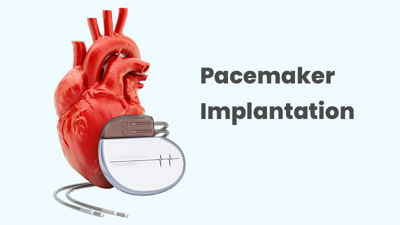 Pacemaker Implantation